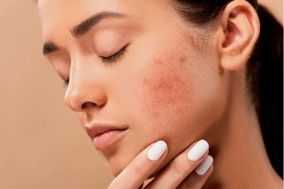 tratamiento facial acne
